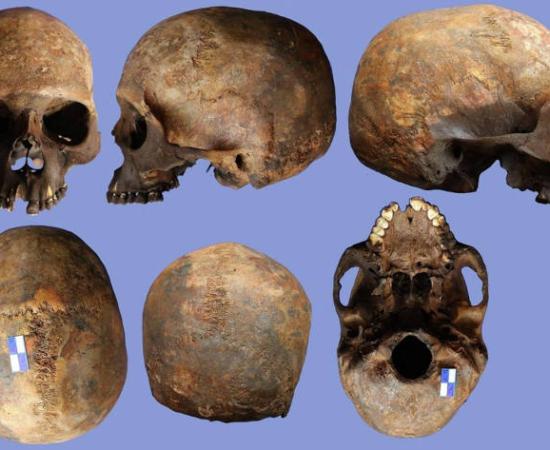 Skull 2N showing evidence of rare Apert syndrome.