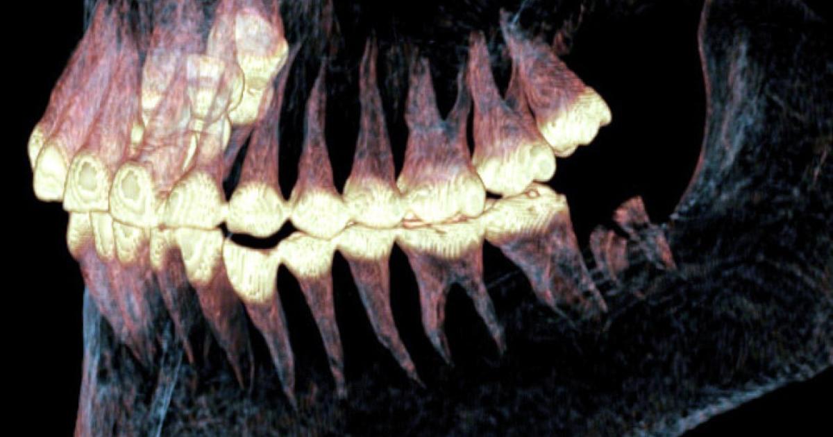 Xray of the jaw of the Pazyryk mummy found to have had jaw surgery.