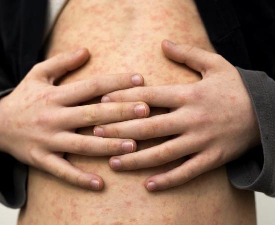 A boy with the measles. Credit: bilanol / Adobe Stock