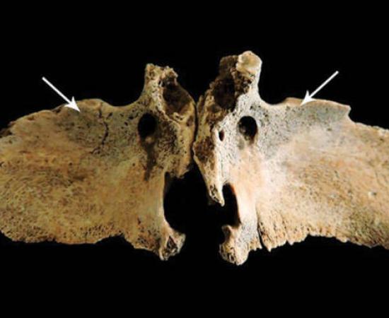 New bone on the greater wings of the sphenoid bone, suggestive of vitamin C deficiency in Roman Briton. 